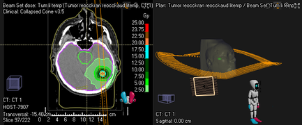 Screenshot Raystation: Stereotaxie kraniell