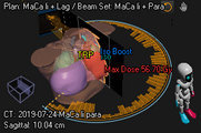 Screenshot Raystation: Mamma links Beams